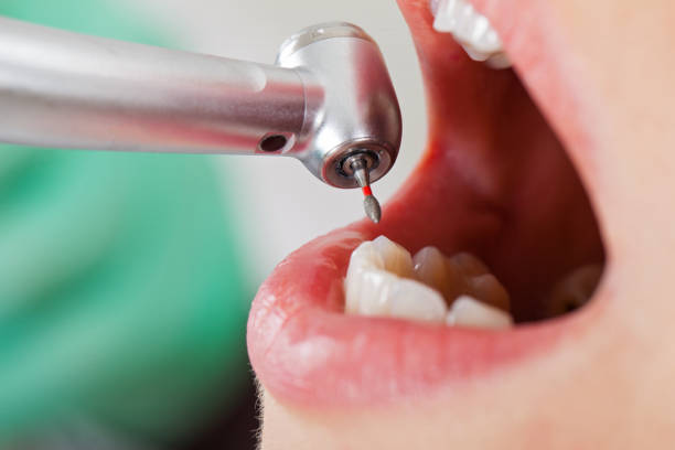 Emergency Dental Filling Replacement in OH